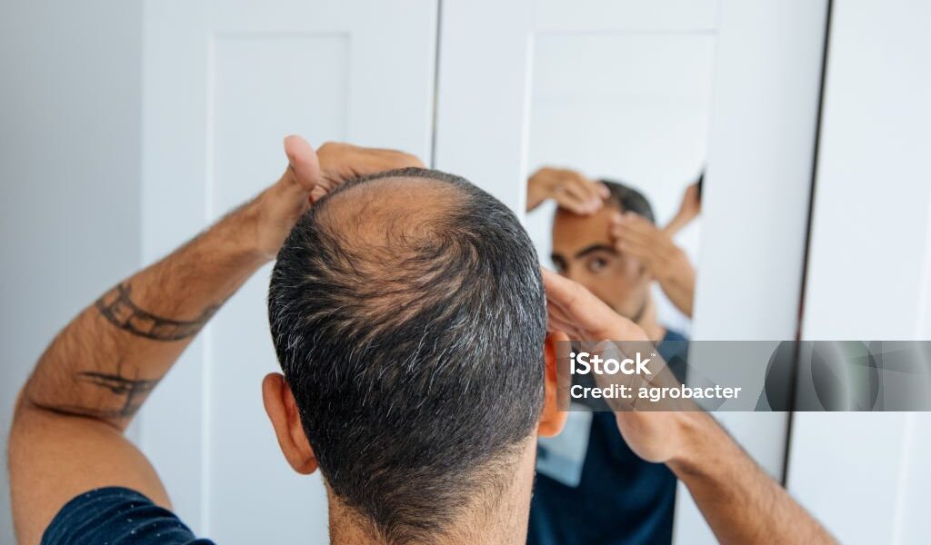 hair loss