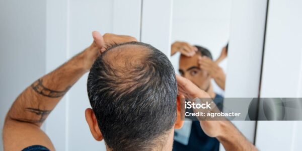 hair loss