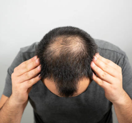 does testosterone cause hair loss