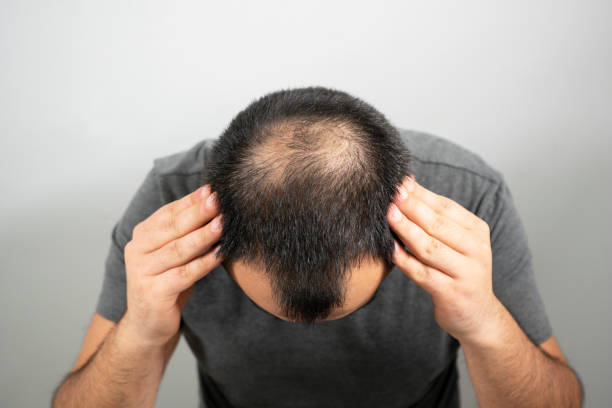 does testosterone cause hair loss